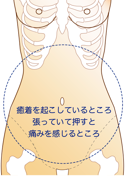 足のうらがしびれ 痛みます 末梢神経障害 お灸の治療とセルフケア 2 事務局ブログ 森からの便り